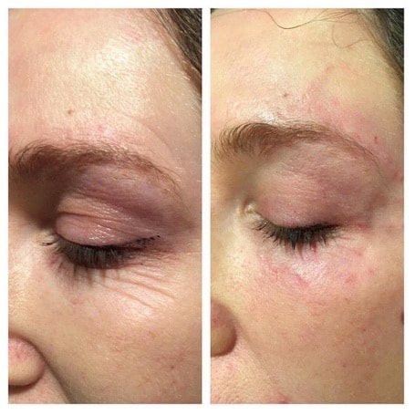 viscoderm