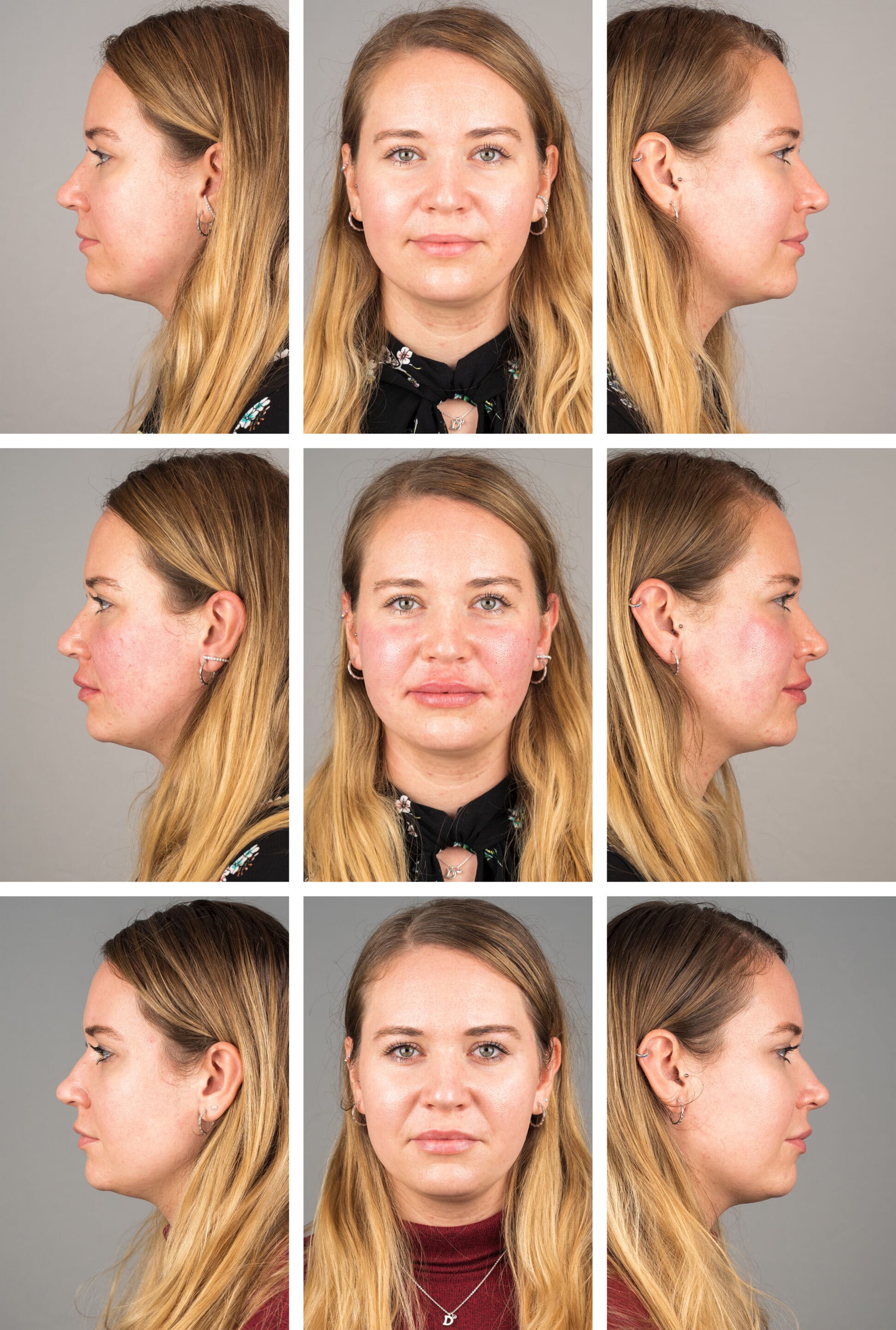 neus-lippenplooi-voor-en-na