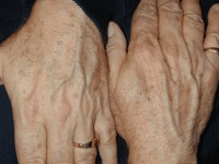 Melasma