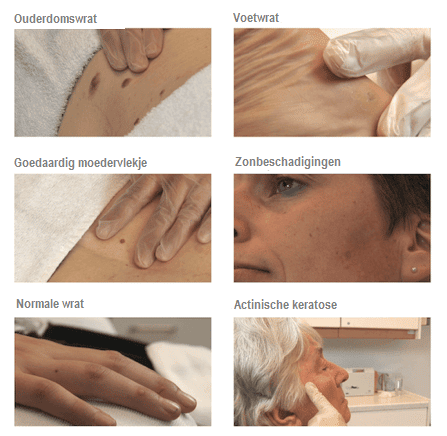 Meest-voorkomende-indicaties-CryoPen