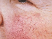 Rosacea-papulosa-2