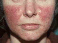 Rosacea-papulosa-3