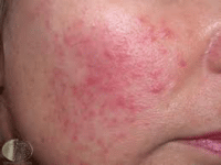 Rosacea-papulosa