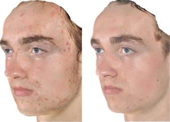Acne