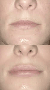 lippen-voor-en-na-2