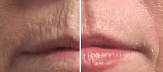 lippen-voor-en-na