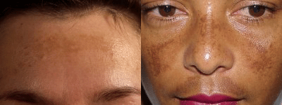Melasma