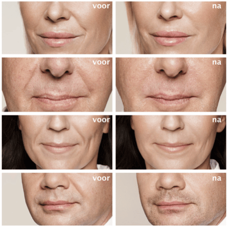 neus-lippenplooi-voor-en-na