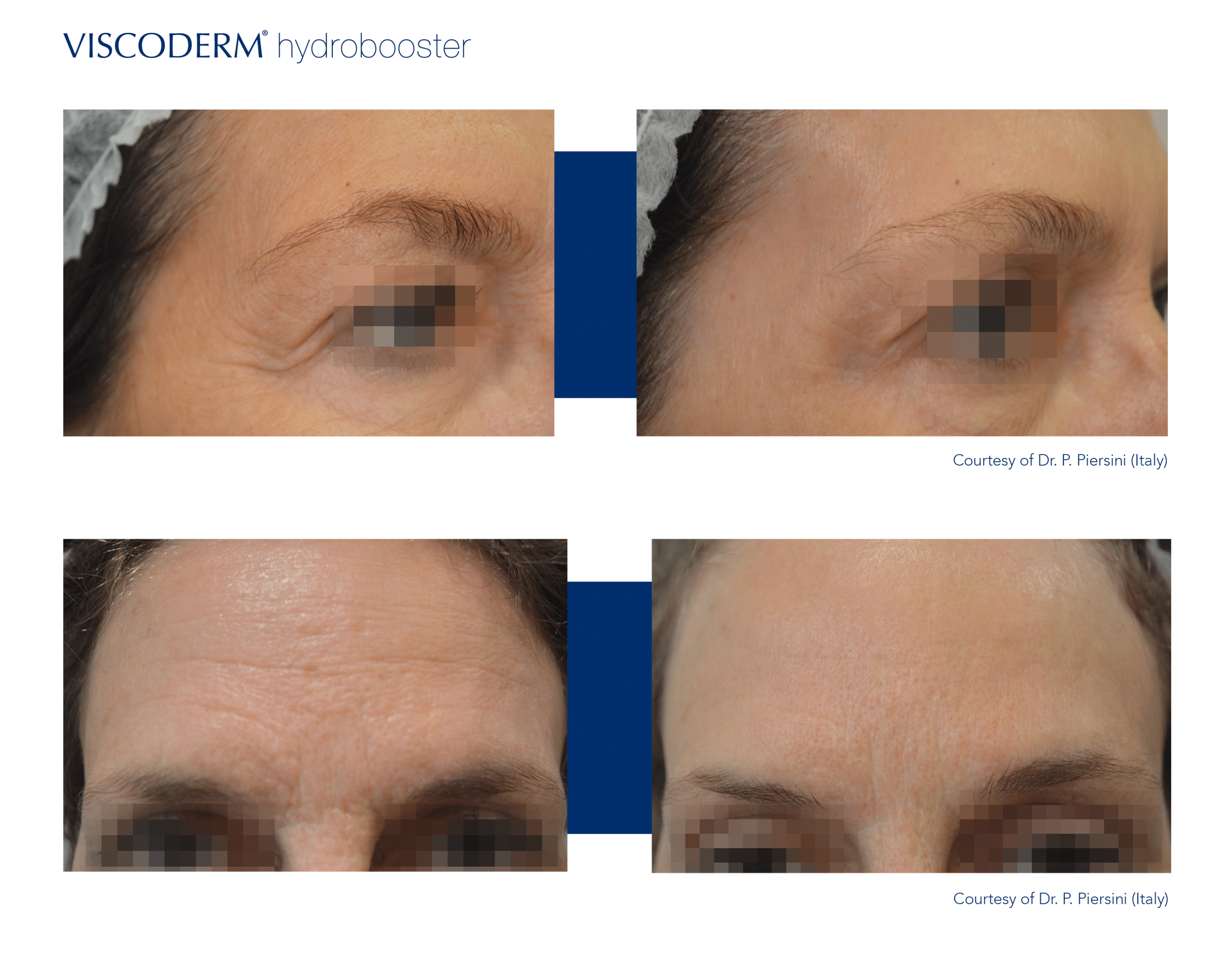 viscoderm